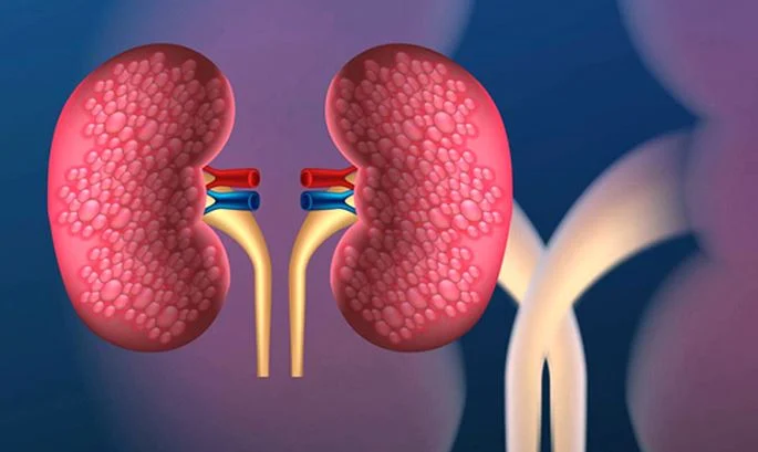 Uncontrolled diabetes, high blood pressure blamed for kidney disease: experts