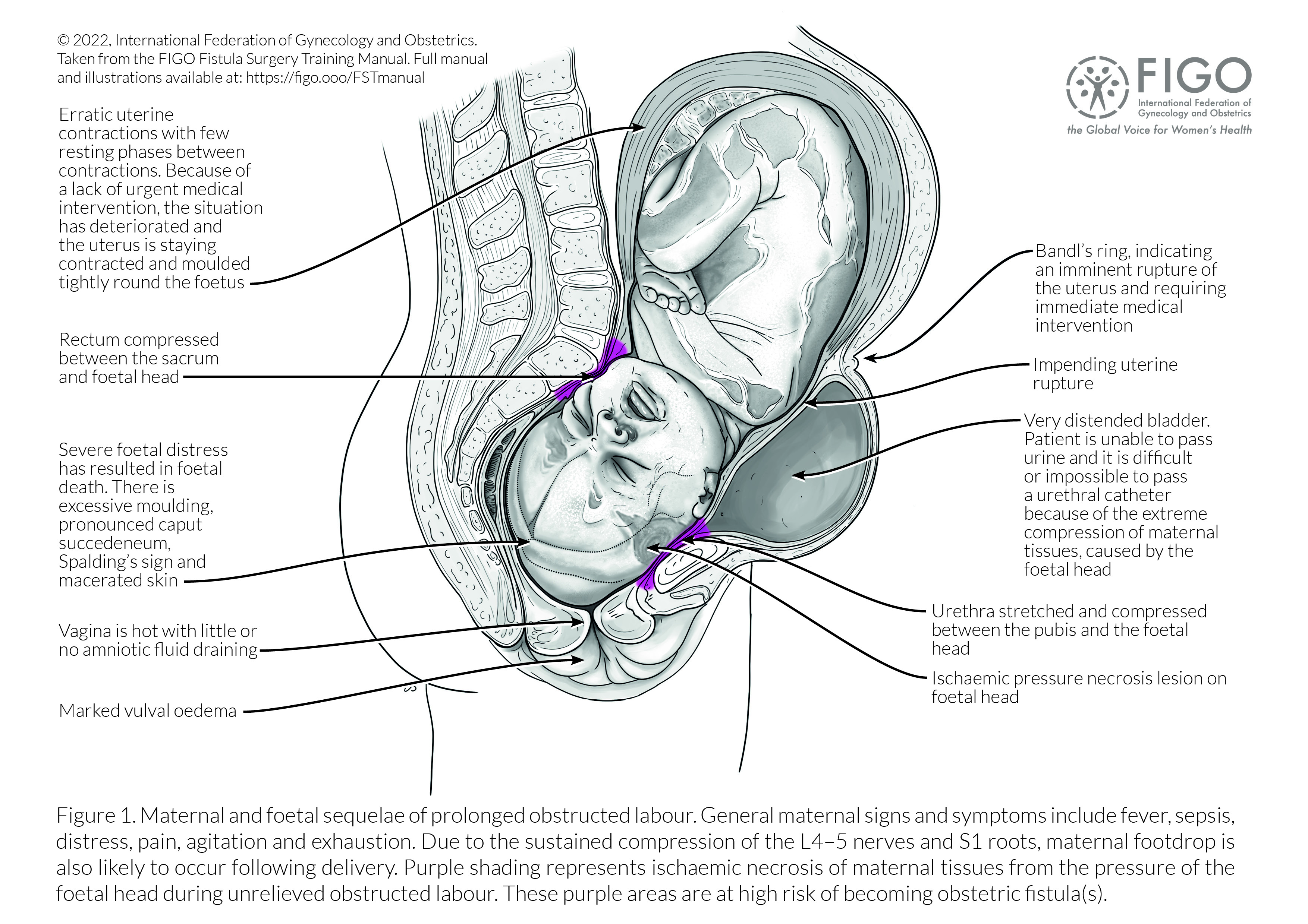 Bringing obstetric fistula patients under treatment underscored 